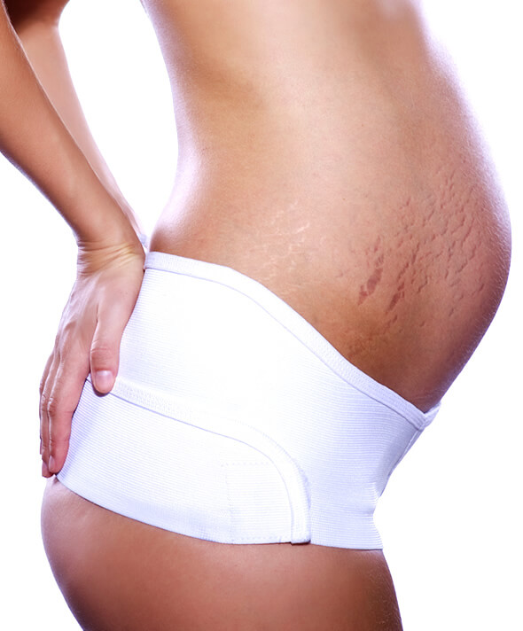 pregnant woman belly with purple stretch marks