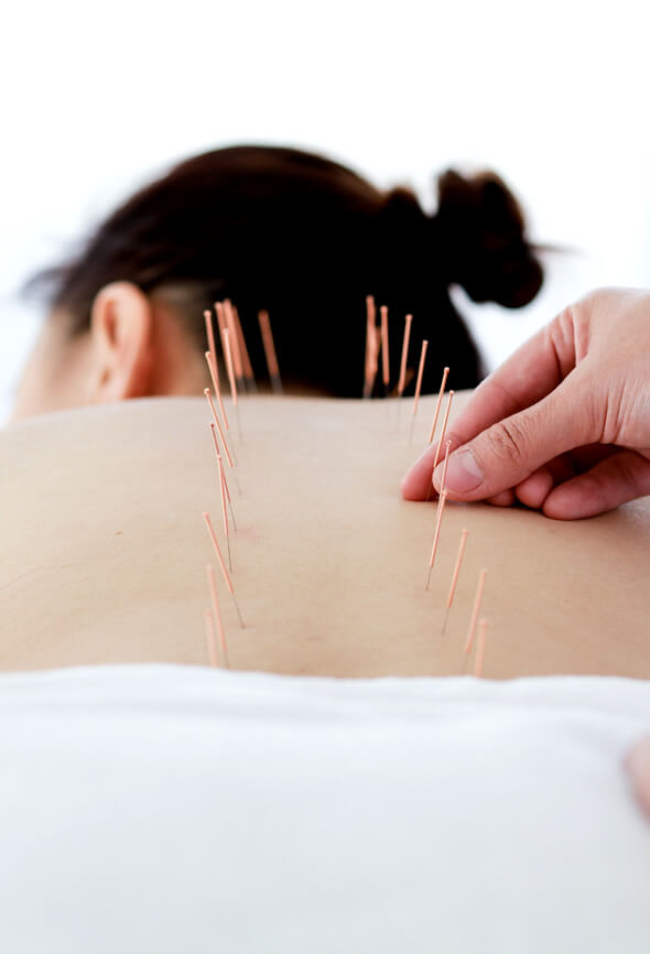 acupuncture
