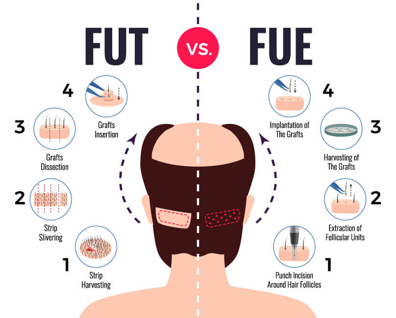 fut vs fue hair transplant infographic