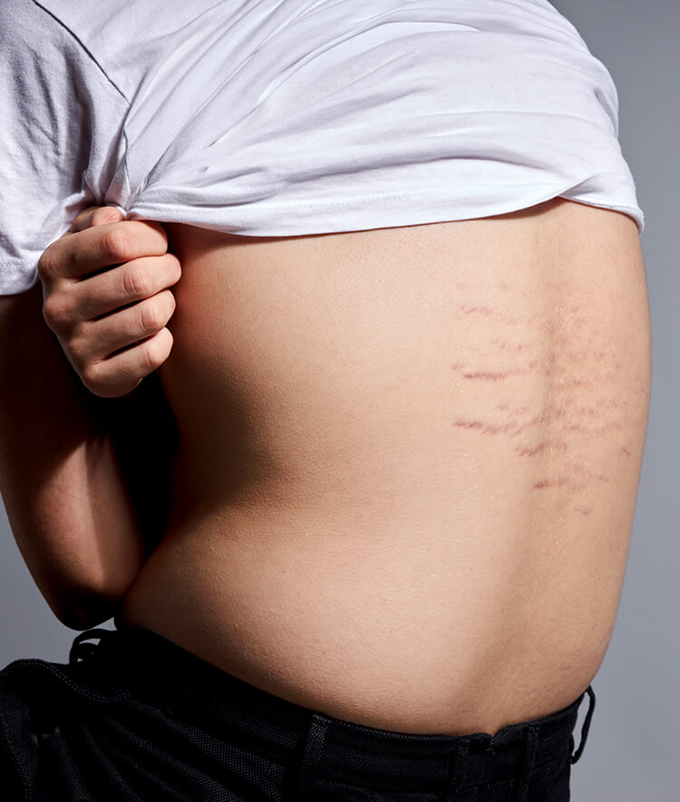 young person with fresh purple stretch marks on back