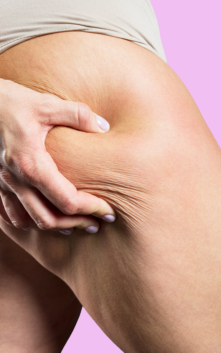 woman touching her sagging skin on legs