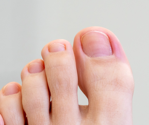 toenail cut in bad shape example