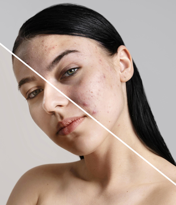 woman choosing between dermatologist vs esthetician for acne problem