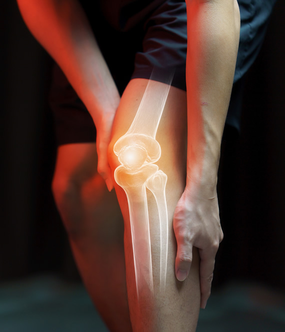 person with arthritis in the knee joint