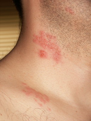 Zoster blisters on neck and shoulder.