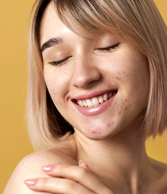 person with acne as one of the most common skin issues