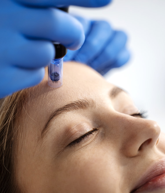 person undergoing microneedling procedure for acne scars