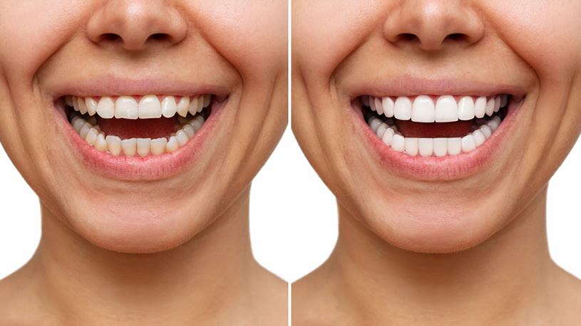 smile difference before and after dental veneers installation