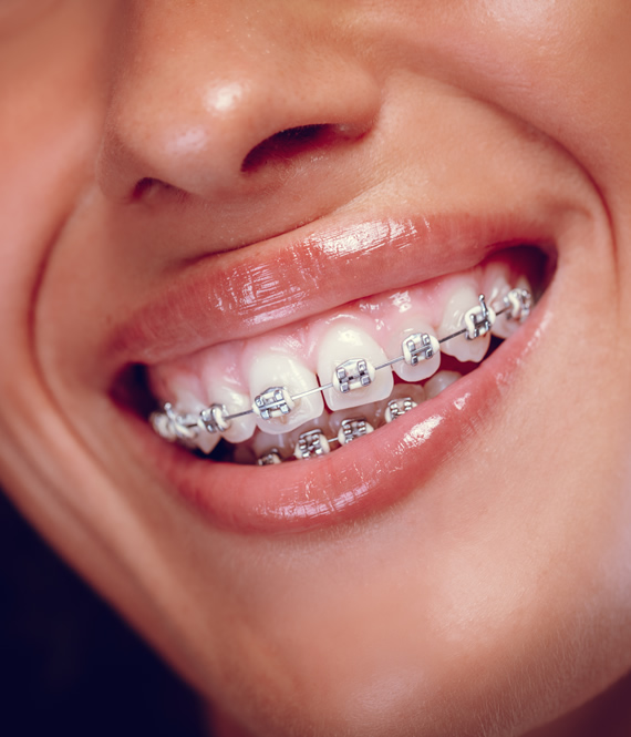 orthodontic braces close up
