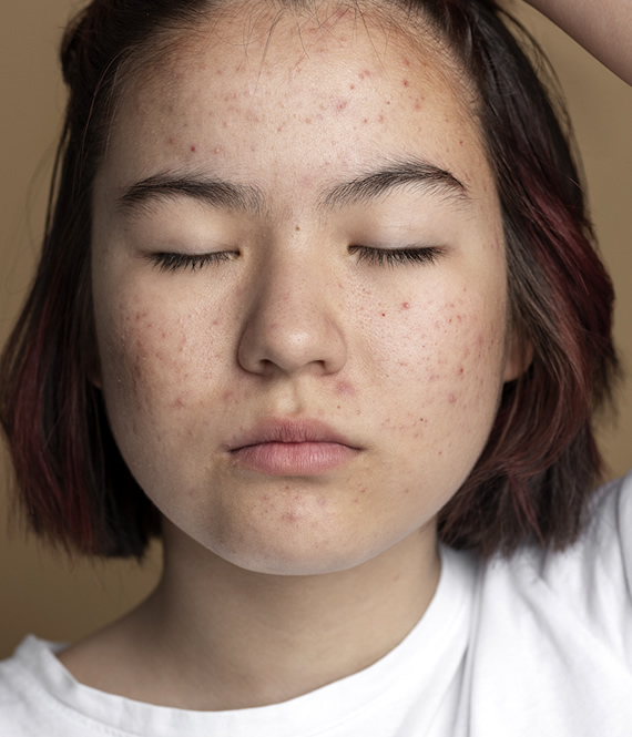 facial skin with acne scars
