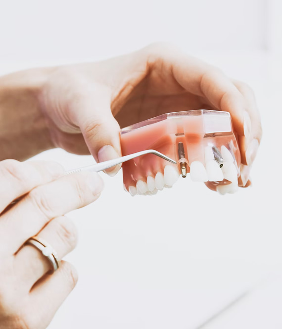 dentist shows dental implants